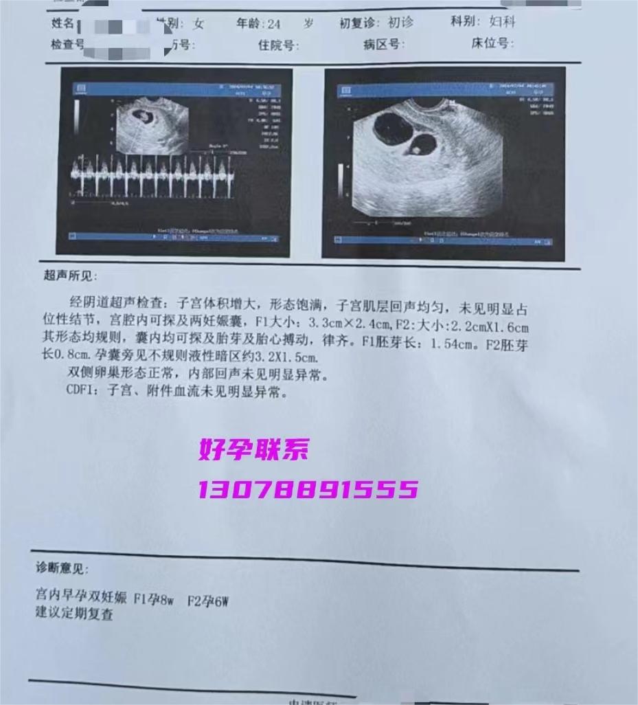 多囊做试管成功案例，分享这对小夫妻试管一次抱俩的故事