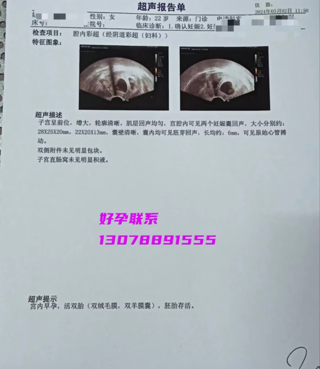 双胎试管成功案例，快来接这位年轻妈妈的好“孕”气吧